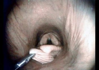 Figure 3. Bronchoesophageal grasping forceps are used to manipulate the deflated cyst.