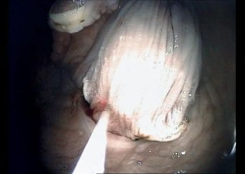 Figure 5. The cyst is elevated to allow an incision to be made in the mucosa overlying its ventral aspect using the transendoscopic diode laser.
