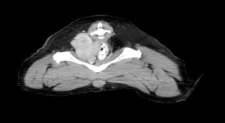 Figure 3a. A CT scan used for the assessment of tumour size and local invasiveness of the primary tumour (anal sac gland adenocarcinoma on the right side) in a dog for surgical planning.