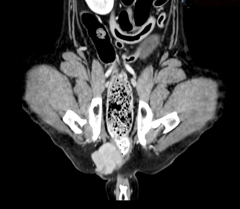 Figure 3a. A CT scan used for the assessment of tumour size and local invasiveness of the primary tumour (anal sac gland adenocarcinoma on the right side) in a dog for surgical planning.