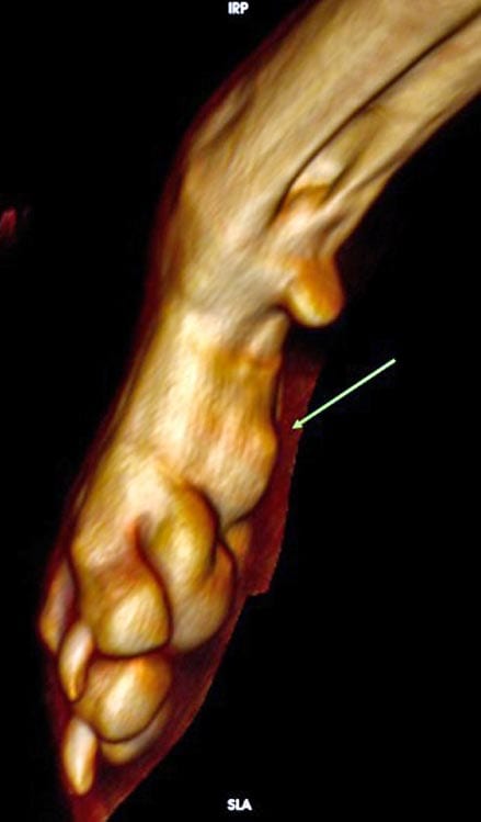 Figure 4a. A 3D reconstruction of a plasma cell tumour at the level of the palmar surface of the left front paw of a 13-year-old cross-breed dog.