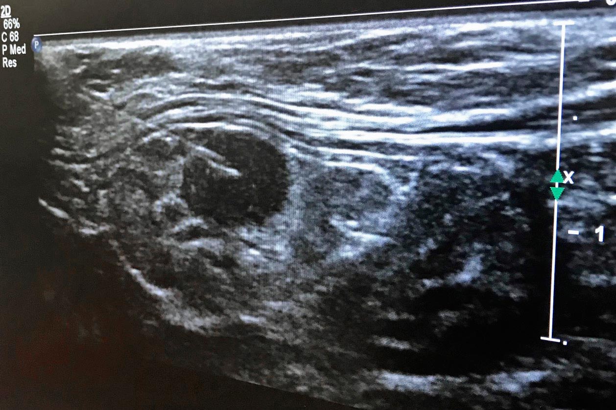 Figure 5b. The ultrasound image shows the tip of the needle in the centre of the enlarged lymph node.