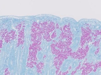 Johne’s disease