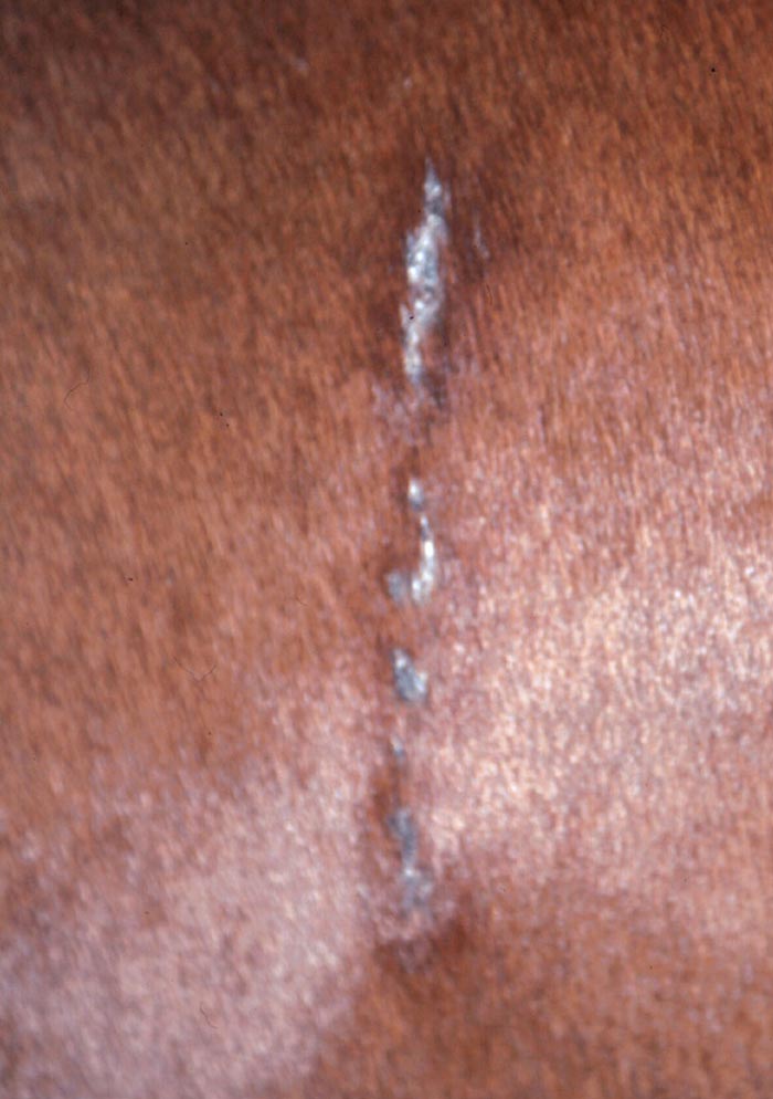 Figure 2. Characteristic linear keratosis lesion requiring no further diagnosis or treatment.