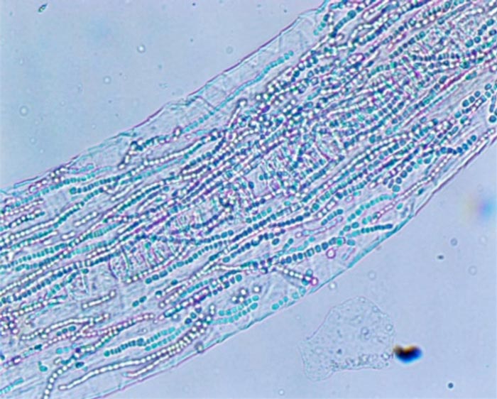Figure 7. Fungal hyphae visible within an infected hair shaft, allowing a confident and rapid diagnosis of dermatophytosis.