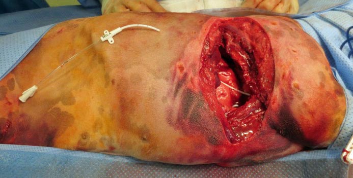 Figure 8. Placement of a Mila thoracostomy tube following exploratory thoracotomy for penetrating thoracic wall and pulmonary trauma. Image: © AHT, Newmarket.