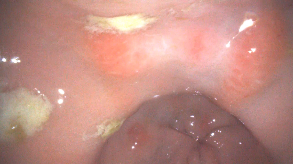 An image taken during a gastroscopy using the Endo-i®.