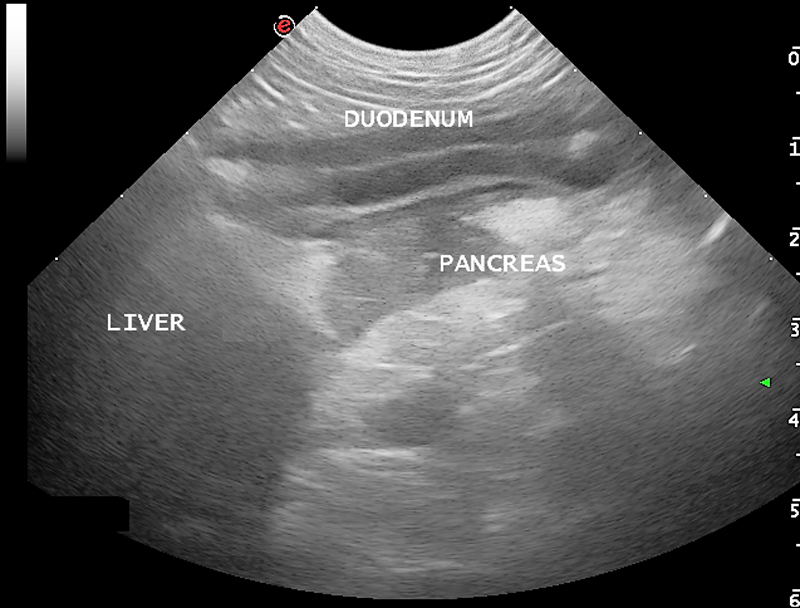 Pancreatitis-Image---Pancreatitis