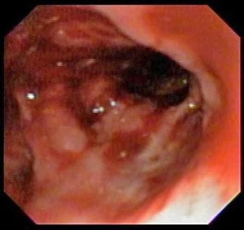Figure 1b. Endoscopy revealed a conspicuous bronchial foreign body in a six-year-old male cross-breed dog weighing 35kg with a chronic cough.