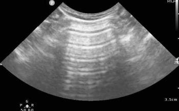 Figure 2a. This normal or dry lung showed only horizontal A-lines. Where parenchymal or interstitial disease is present, vertical B-lines and lung artefacts arise.