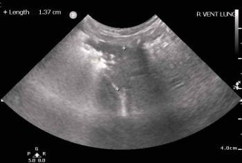 Figure 2b. In this five-month-old neutered female dachshund with megaoesophagus, the right ventral lung showed evidence of aspiration pneumonia. Many consolidated B-lines appear on the left of the image (tending to infinity), while, on the right, consolidated lung is seen (plus callipers). The small amount of gas within this tissue classifies this as a “shred” sign and is analogous to an alveolar pattern on a radiograph.