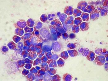 Figure 3b. When the bronchoalveolar lavage fluid was examined cytologically, it showed eosinophilic inflammation.