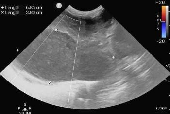 Figure 4a. A three-year-old male neutered Maine Coon cat was diagnosed with a pyothorax cytologically. Further imaging with ultrasound and CT revealed a presence of a paraoesophageal abscess. This with thoracic ultrasound – callipers delineate the abscess.