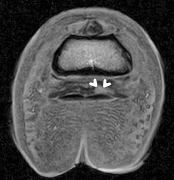 Figure 2. Transverse T1W GRE image of the foot. The white arrows indicate a focal hyperintense lesion along the dorsal surface of the deep digital flexor tendon, representing a surgically confirmed granuloma.