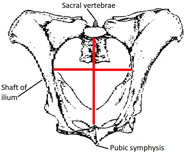 Figure 1. The internal width and height of the pelvis are measured and the total area calculated.