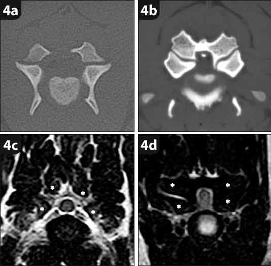 Figure 4. CT images (4a and 4b) and T2-weighted transverse MRI scans (4c and 4d) at the level of the articular processes of a normal dog (4a and 4c) and 24-month-old great Dane with osseous-associated cervical spondylomyelopathy. When comparing 4a and 4b, it can be appreciated how the articular processes are enlarged – resulting in a stenotic vertebral canal. Although the anatomy of the articular processes is more difficult to appreciate in 4c and 4d, the enlarged articular processes result in bilateral lateral spinal cord compression in 4d. The articular processes are indicated by asterisks.