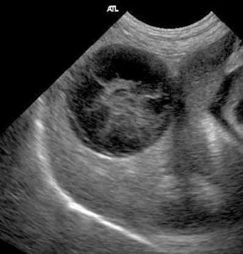 Figure 4. Ultrasound of the liver allows examination of the parenchyma and detailed inspection of the biliary tree. In this case, the stellate appearance of echogenic bile within the gall bladder is consistent with mucocoele formation. 