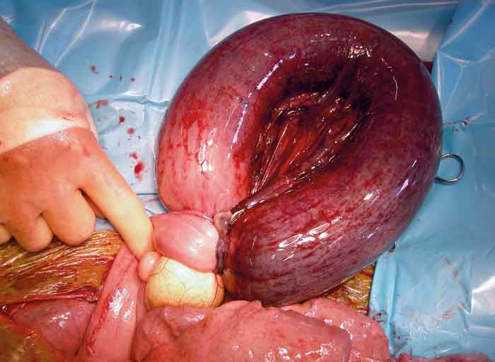 Figure 2. Intra-operative view of a small intestinal strangulation due to a pedunculated lipoma.