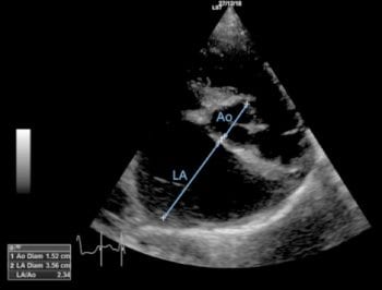 Figure 3. Measuring the left atrial to aortic root ratio (LA:Ao) from the right parasternal short-axis view at the level of the aortic valve.