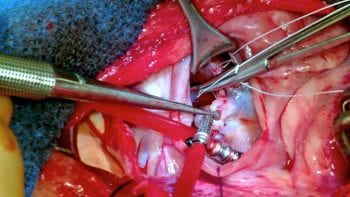 Figure 6. Intra-operative image of mitral valve surgery.