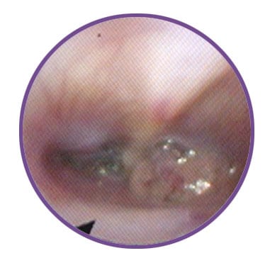 Rhinoscopy of the same patient in <strong>Figure 1</strong>; guided biopsies of the mass confirmed a diagnosis of nasal carcinoma. The patient was treated with radiotherapy.