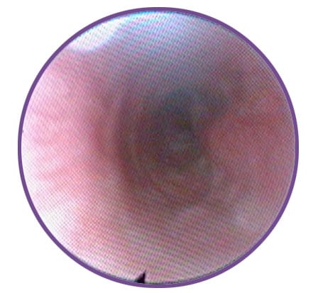 Endoscopic evaluation of the distal trachea in a patient with grade I-II/VI tracheal collapse.