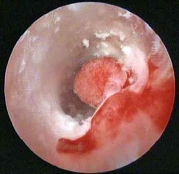 Figure 1. Video otoscopy image of the horizontal ear canal, showing an exophytic growth causing partial obstruction and allowing debris to get trapped behind (in front of the tympanic membrane). Histopathology confirmed an inflammatory polyp with bacterial infection.