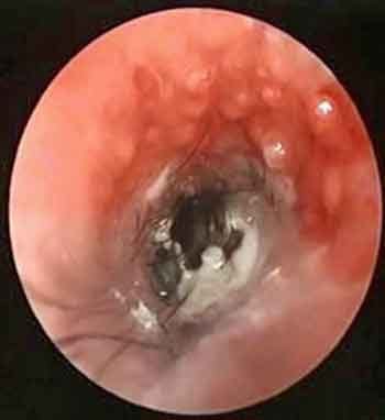 Figure 3. Video otoscopy image of the vertical ear canal, showing proliferation/hyperplasia and erythema/erosion of the ear canal wall. The “bubble wrap” appearance of the proliferative changes is suggestive of dilation of ceruminous glands, which can eventually rupture and exacerbate inflammation.