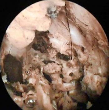 Figure 4a. Video otoscopy images of Pseudomonas species otitis, showing abundant malodorous, ceruminous to purulent discharge filling the ear canal lumen pre-flushing.