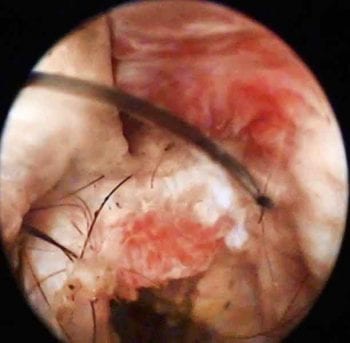 Figure 4b. A severely abnormal ear canal, with excessive soft tissue formation and erosion, is revealed in the same ear post-flushing.