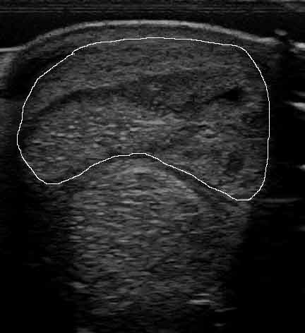 Figure 1. Ultrasonographic image of a markedly enlarged and disrupted superficial digital flexor tendon in the mid-metacarpal region of a showjumping horse.