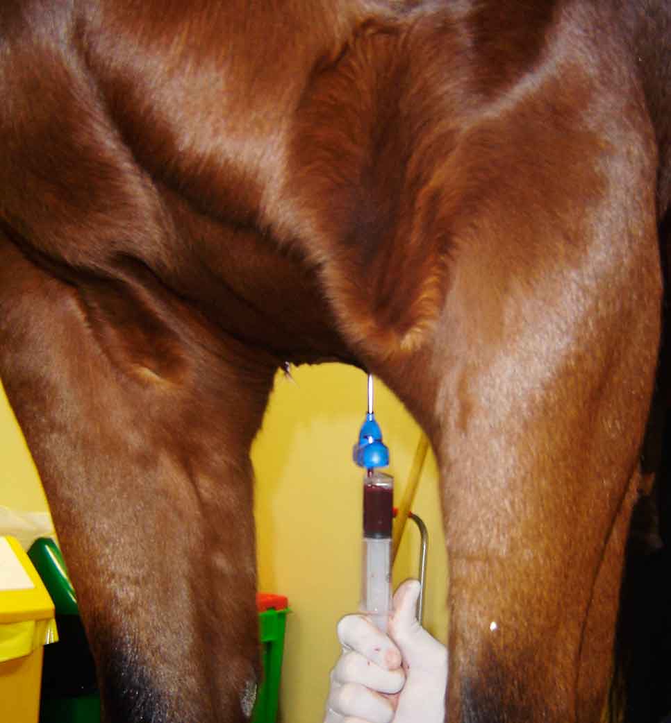 Figure 2. Bone marrow aspirate being collected from the sternum for culture of mesenchymal stem cells.