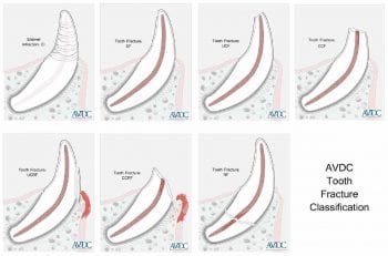 Figure 4. Tooth fracture classification as described by the American Veterinary Dental College. Image: American Veterinary Dental College.