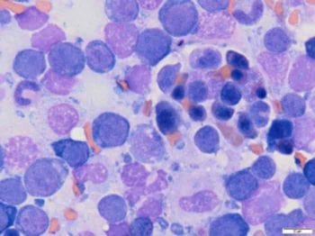 Rubriphagocytosis on cytology of a bone marrow core biopsy.