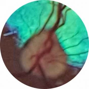 Figure 7. A view with direct ophthalmoscopy. A detailed, magnified view of the fundus.