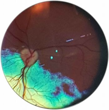 Figure 5. Actual orientation of the fundus.
