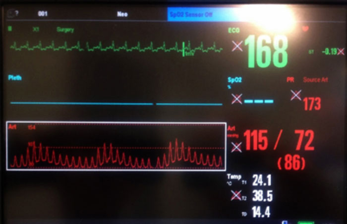 Arterial line trace; systolic pressure variability "arterial swing".