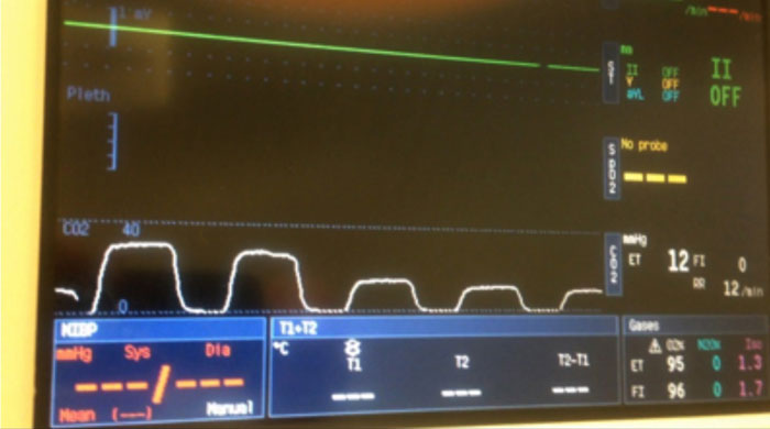 Capnograph showing reduction of CO<sub>2</sub> indicating sharp decrease in cardiac output.