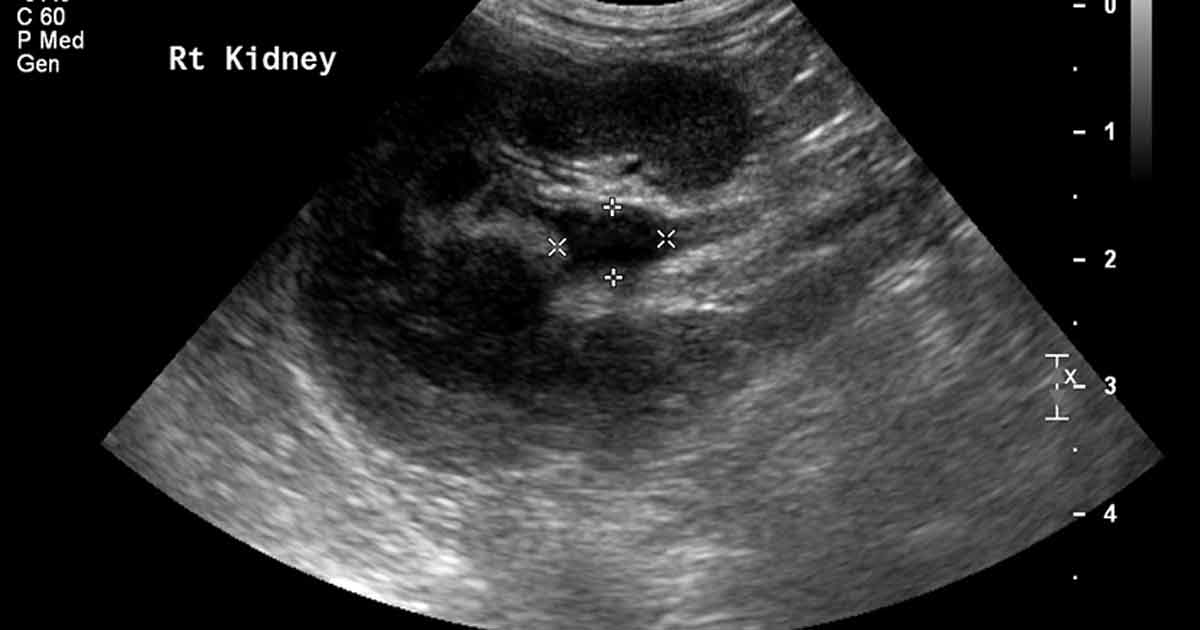 Ultrasound image of the right kidney, showing pyelectasia (renal pelvis dilation) of 8.6mm and surrounding hyperechoic fat.