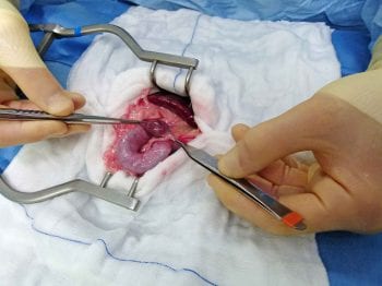 Figure 4. Resection of the intra-abdominal testicle. Image: Benito de la Puerta