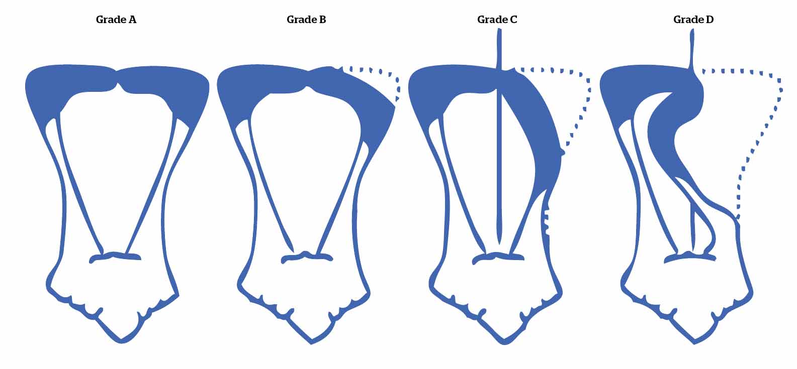 Figure 3. Laryngeal grading system at exercise. Grade A: full abduction of the arytenoid cartilages. Grade B: partial abduction (between full abduction and resting position). Grade C: abduction less than resting position. Grade D: collapse of the arytenoid past the sagittal line dividing the rima glottidis. Image: recreated from Rossignol et al, 2018.