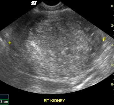 Figure 2. A long-axis ultrasound image of the right kidney of a dog. The central region of the kidney is obliterated by a rounded heterogenous, largely hyperechoic mass lesion. Histopathology of the tumour after excision showed this to be a renal carcinoma. 
