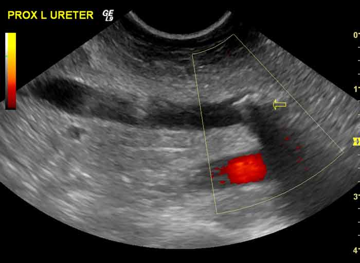 Figure 3. An ultrasound image of the left proximal ureter of a cat containing a ureterolith (hollow arrow) that is causing dilation of the ureter. The ureterolith appears as a hyperechoic interface with strong distal acoustic shadowing. Colour doppler shows blood flow in a vessel deep to the ureter (red area on image). 