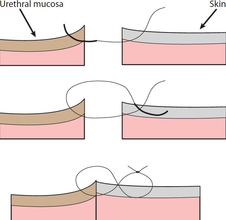 Figure 2. The figure of eight suture.