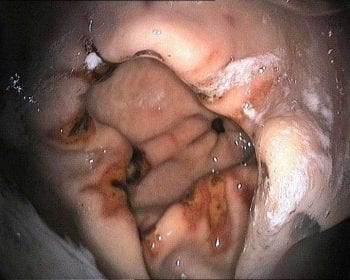 In another example, pictured is depressed, haemorrhagic, fibrinosuppurative, multifocal lesions at the pylorus.