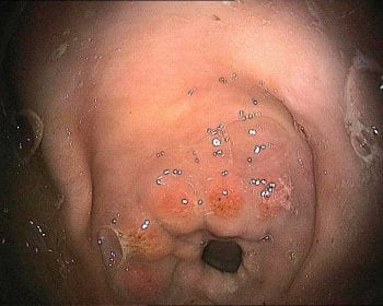 Example of equine glandular gastric disease. Haemorrhagic, multifocal lesions at the pylorus.