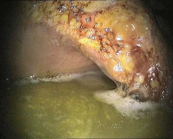 Grade three lesions on the lesser curvature, in another example of equine squamous gastric disease.