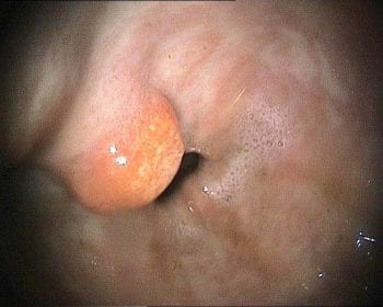 Nodular, hyperaemic, focal lesion at the pylorus in another example of equine glandular gastric disease.