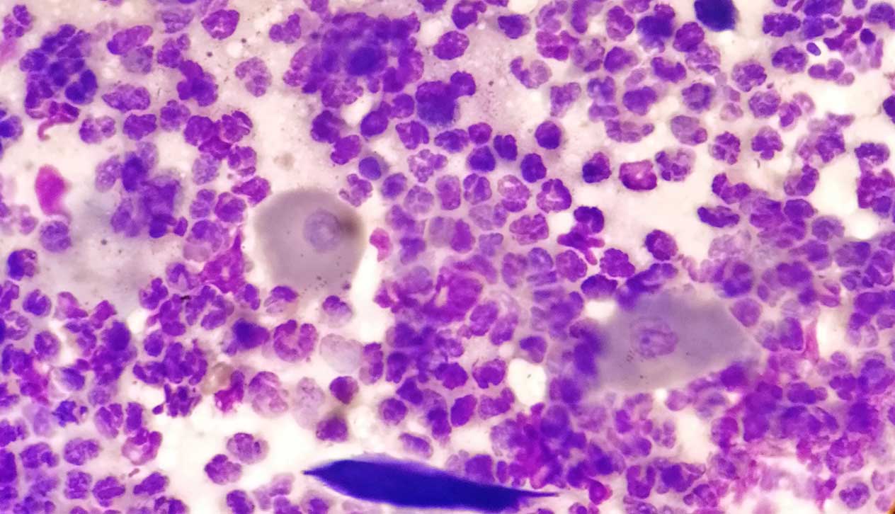 Figure 3b. Cytology supports the clinical suspicion, showing acantholytic cells with abundant surrounding neutrophils, but skin biopsies are required to confirm the diagnosis. 