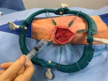Figure 2. Intraoperative local instillation of bupivacaine into a wound site before surgical closure.